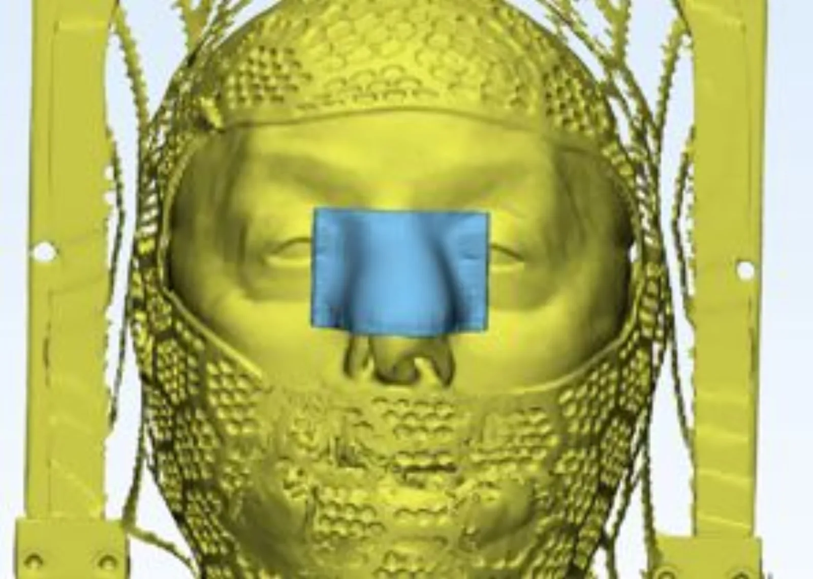 3D scan with radiotherapy mask overlay