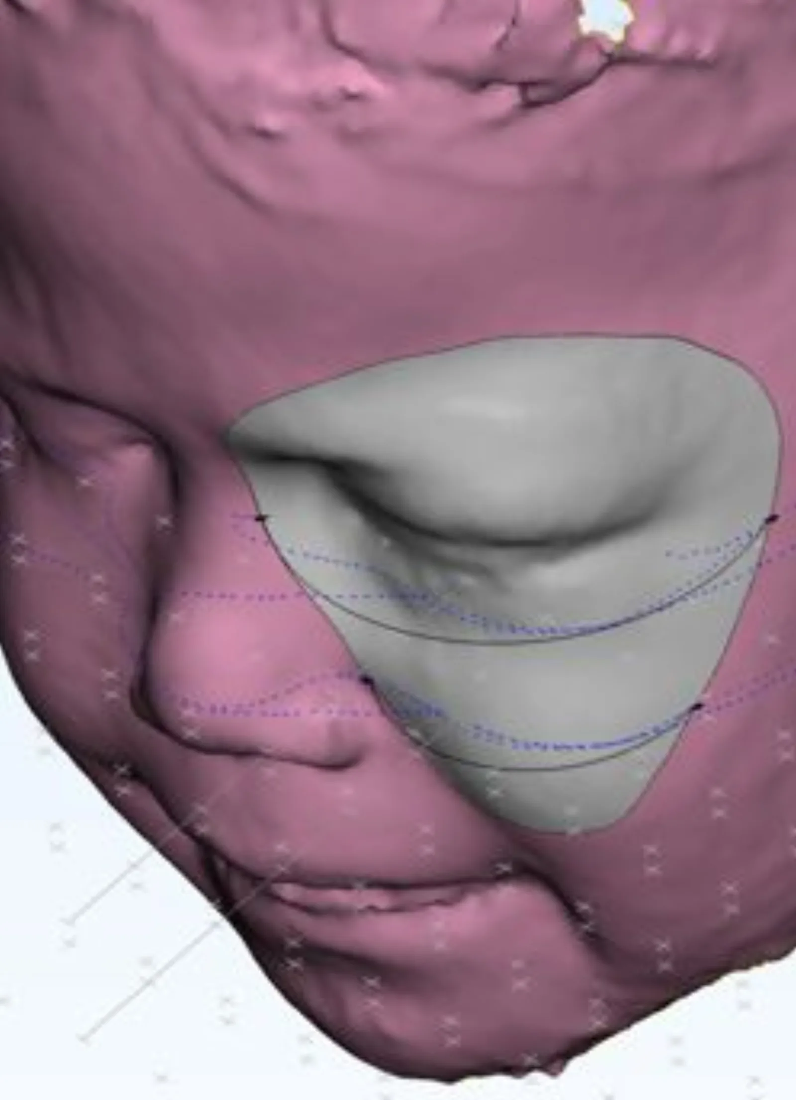 3D facial scan with protective device design overlay